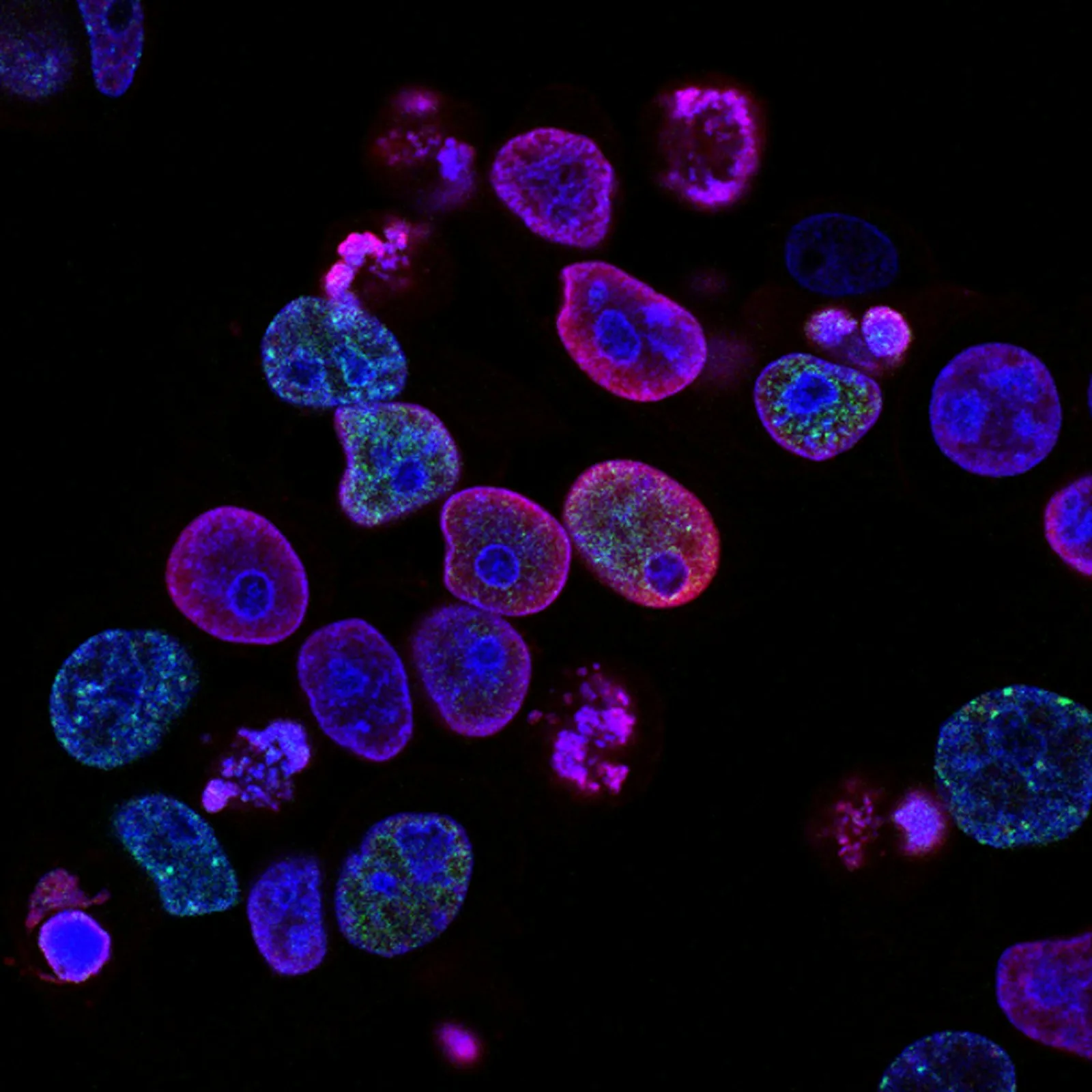 Cellular analysis for autoimmune therapy